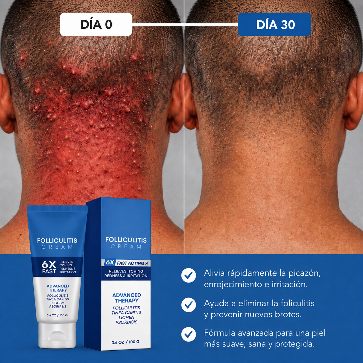 💙Folliculitis Soothing Cream for Folliculitis Scalp Face and Body💙