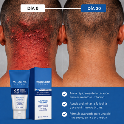 💙Folliculitis Soothing Cream for Folliculitis Scalp Face and Body💙